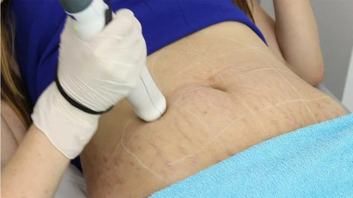stretch marks therapy
